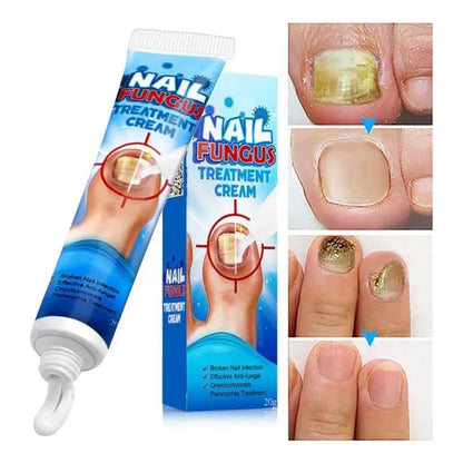 Crema para Hongos en Uñas y Pies