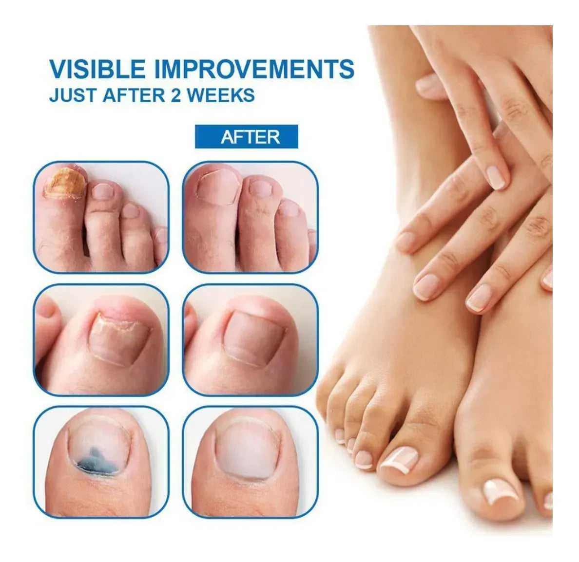 Crema para Hongos en Uñas y Pies