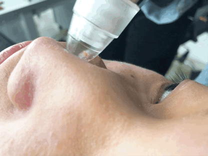 Removedor de Puntos Negros Recargable – Limpieza Facial Profunda con 5 Cabezales