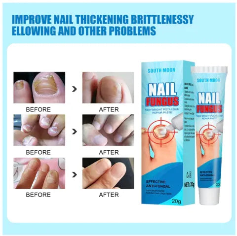 Crema para Hongos en Uñas y Pies