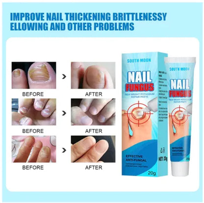 Crema para Hongos en Uñas y Pies