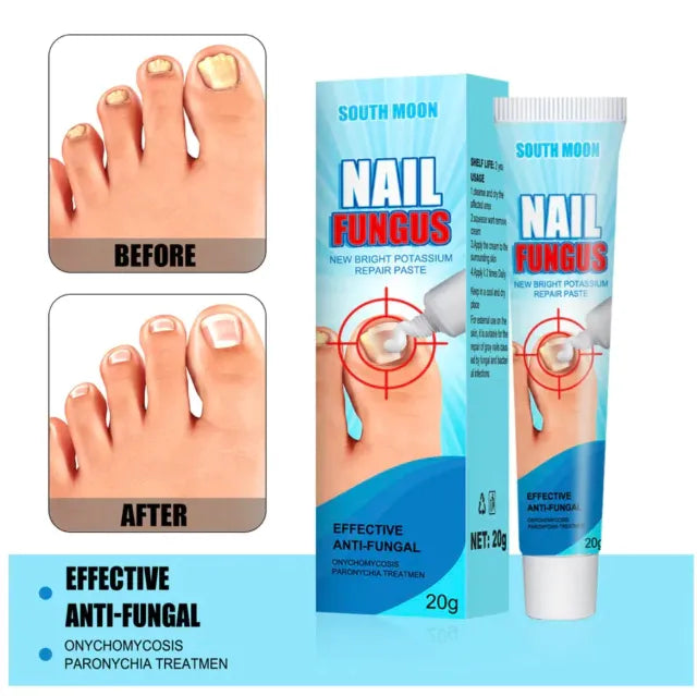 Crema para Hongos en Uñas y Pies