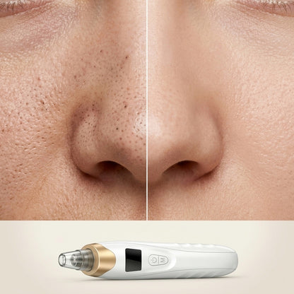 Removedor de Puntos Negros Recargable – Limpieza Facial Profunda con 5 Cabezales